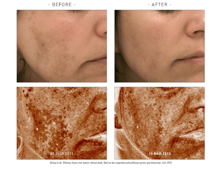 Pigmentation - what causes it and can it be reduced ?